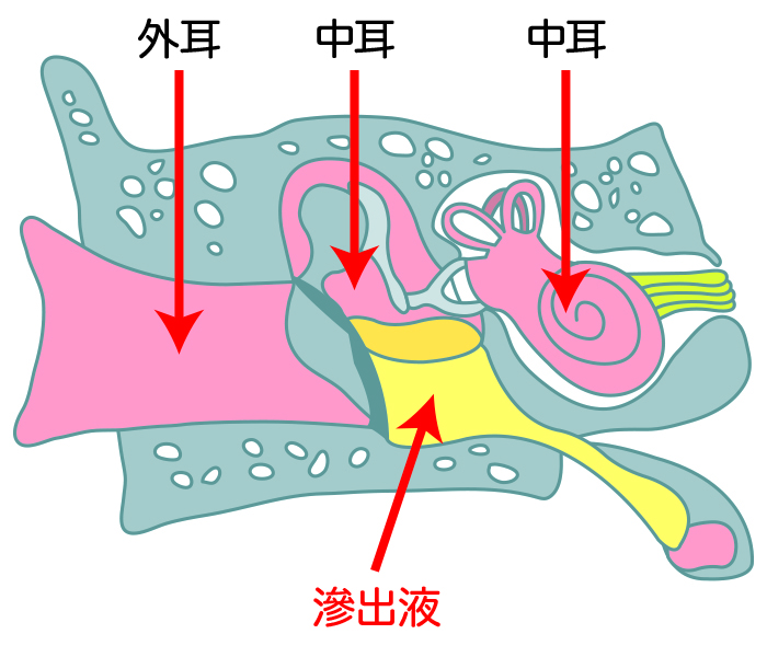 滲出性中耳炎はどんな病気 ？